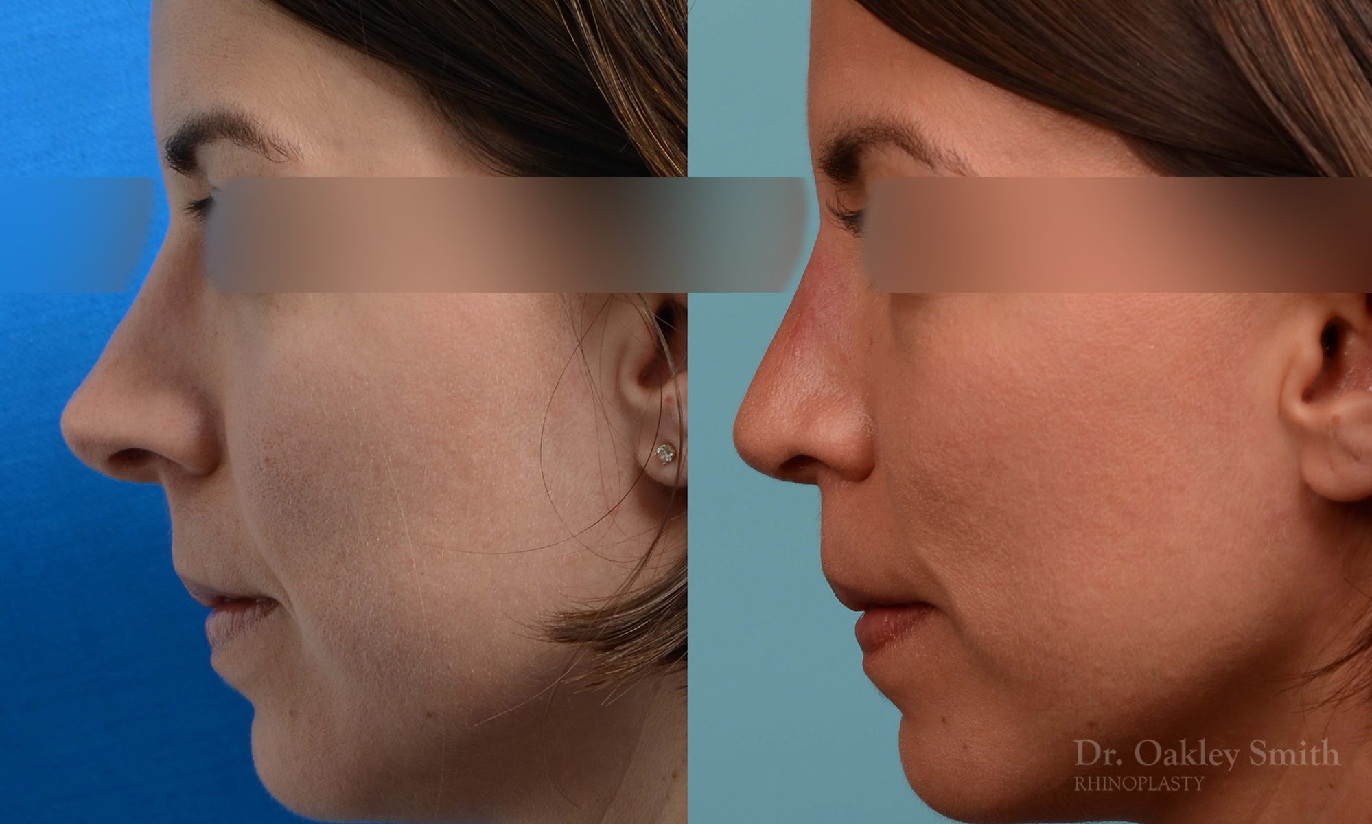 rhinoplasty tip reduction