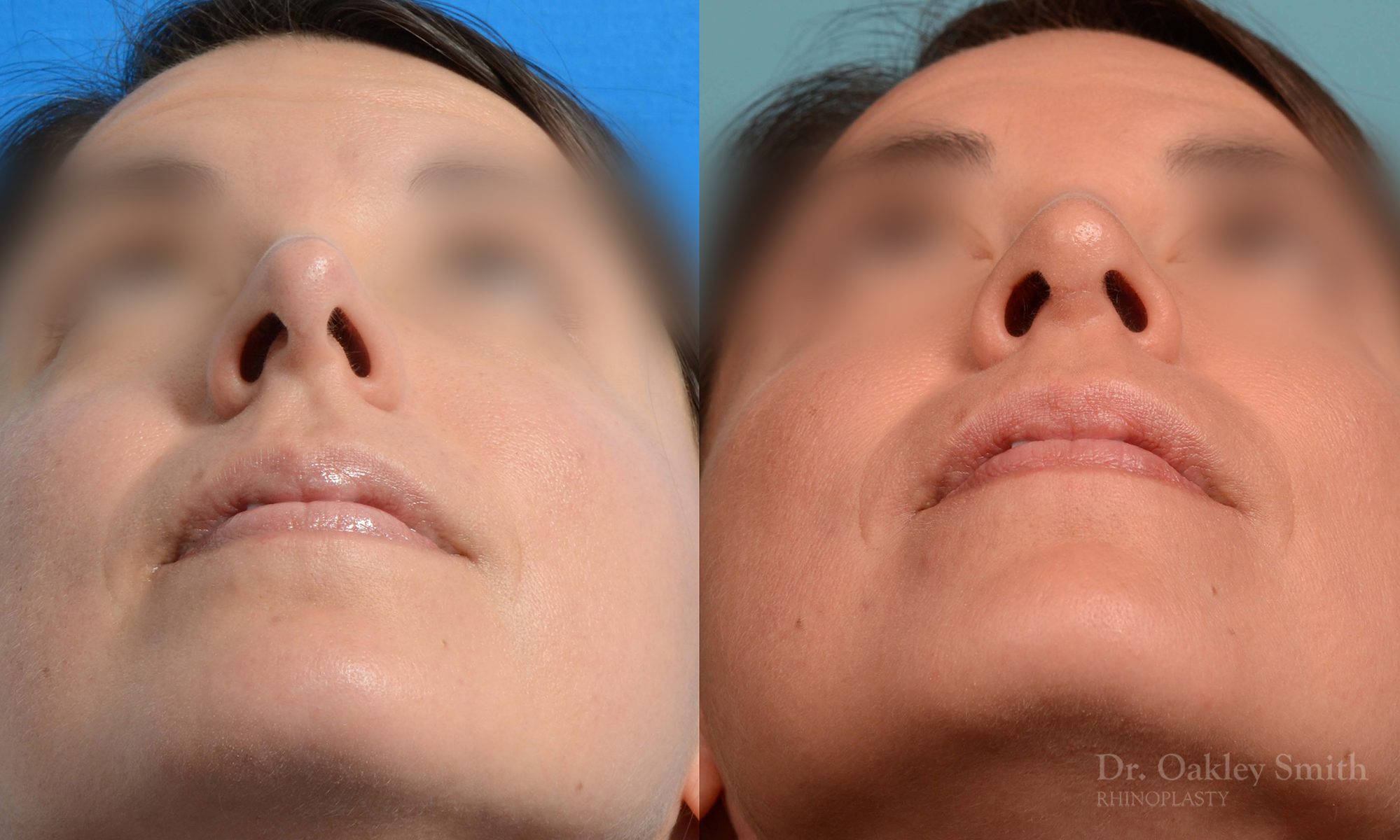 rhinoplasty tip reduction