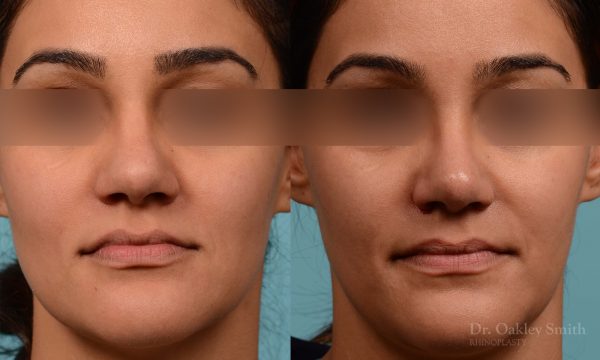 Rhinoplasty before and after