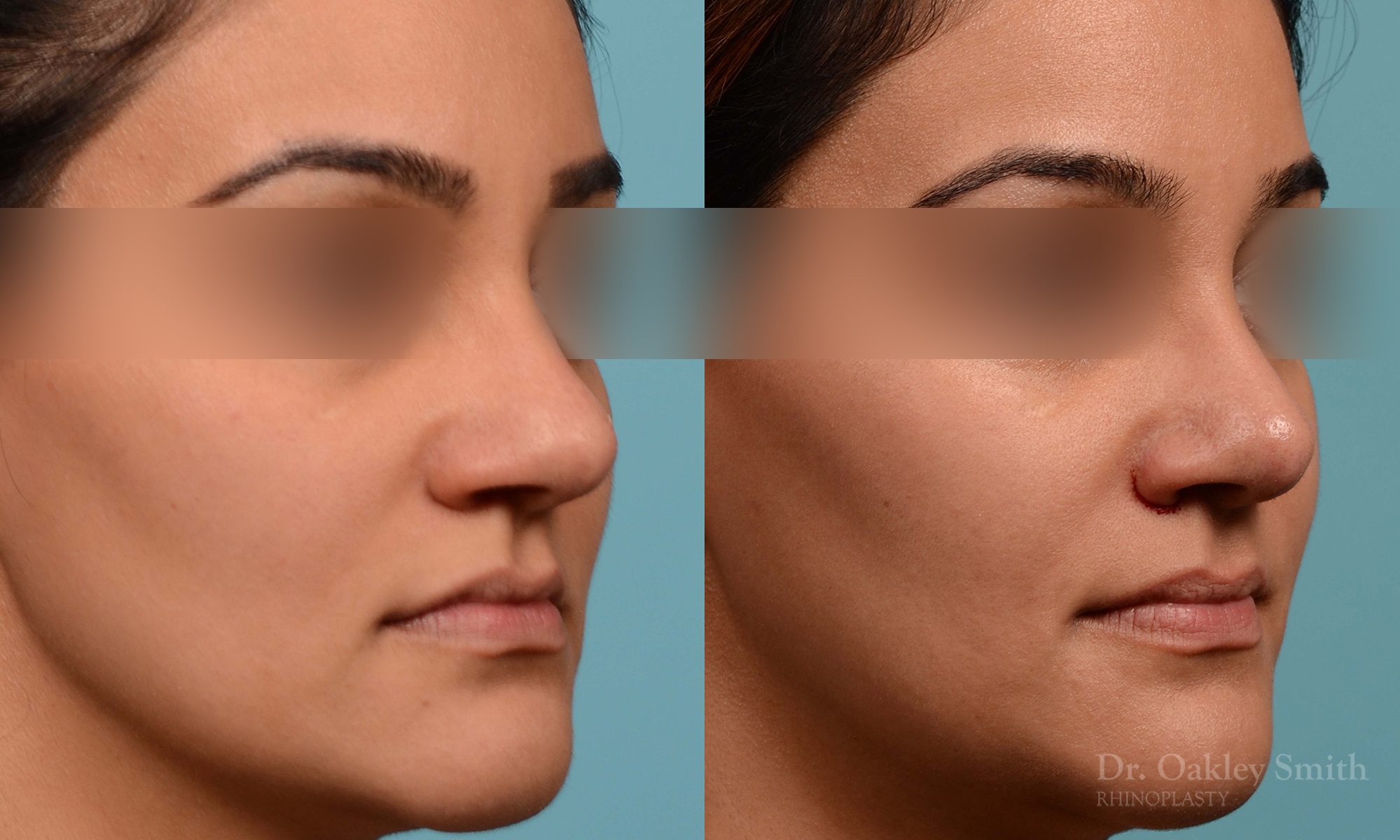 Rhinoplasty before and after