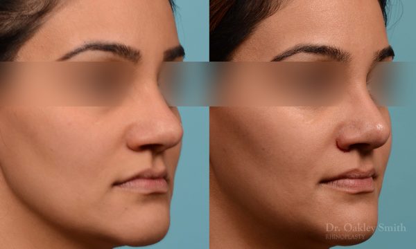 Rhinoplasty before and after