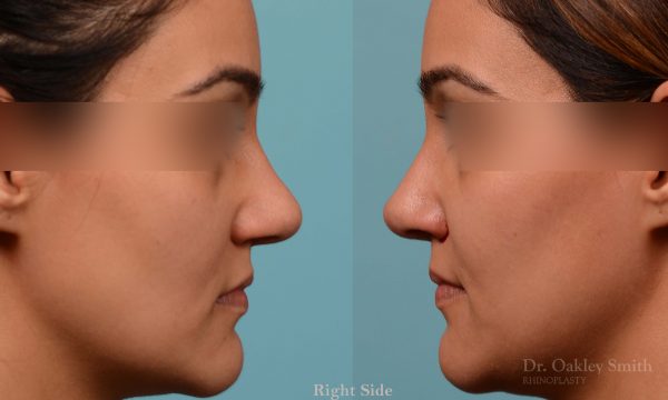 Rhinoplasty before and after