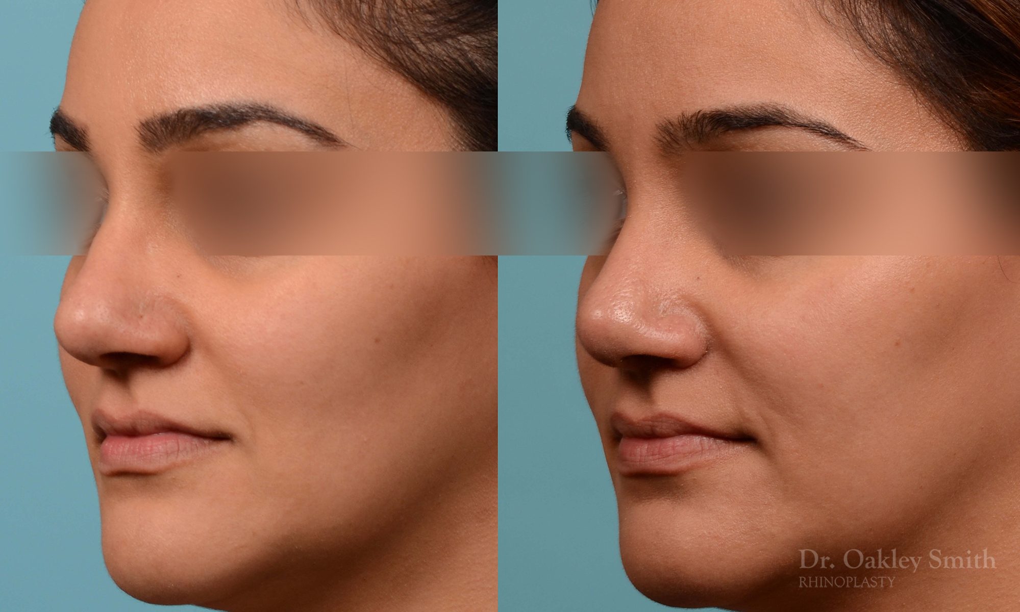 Rhinoplasty before and after
