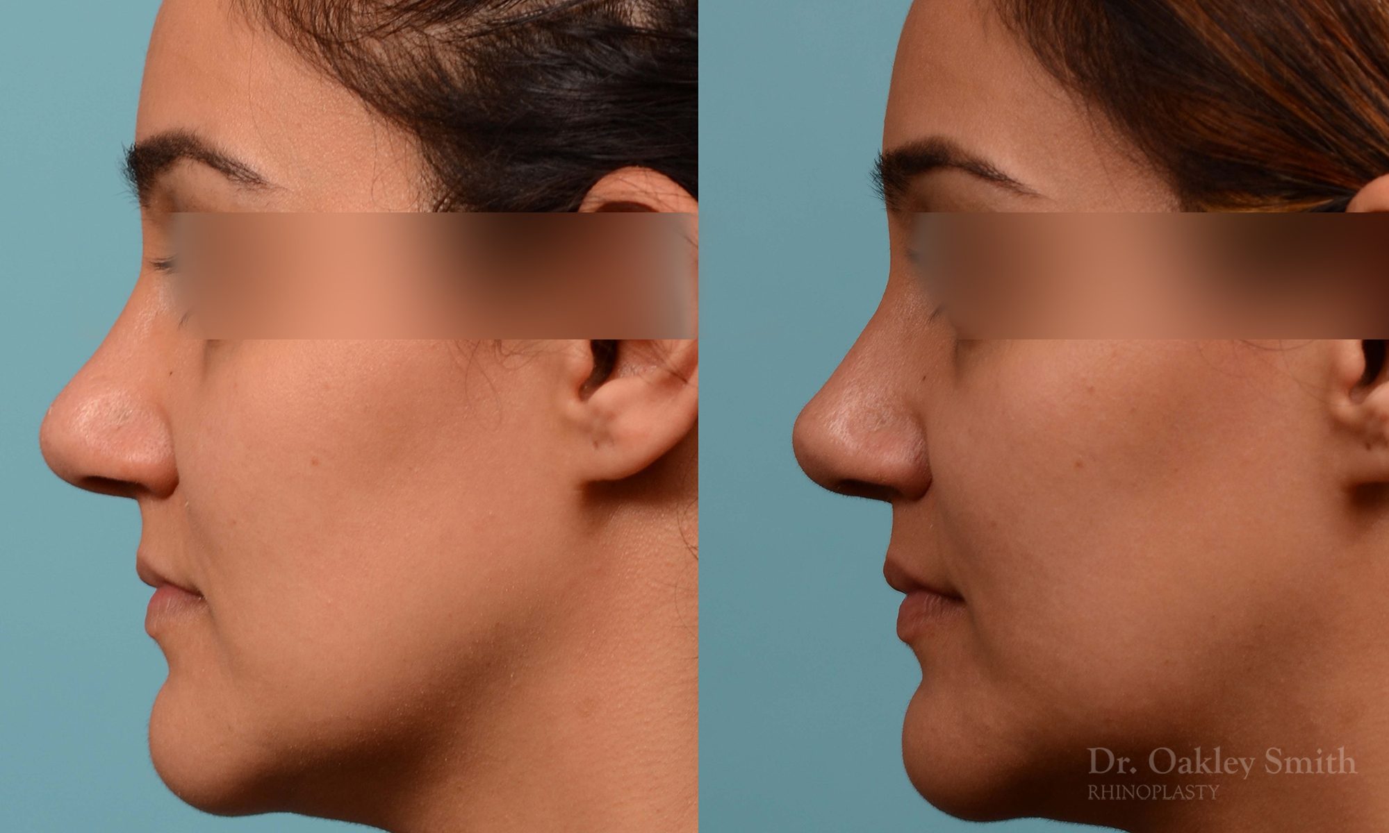 rhinoplasty