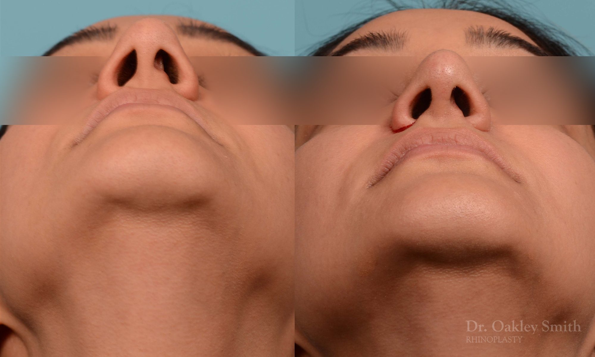 Rhinoplasty before and after
