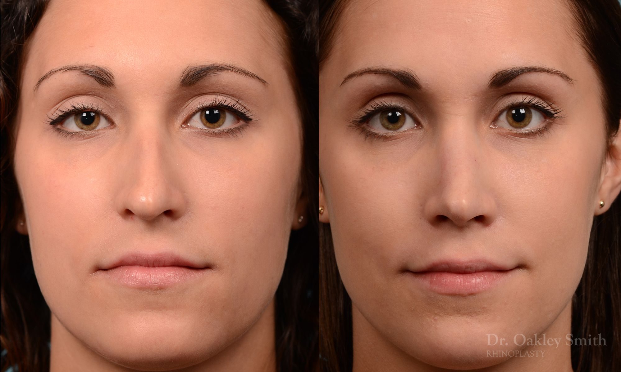 Rhinoplasty Hump removal and straightening