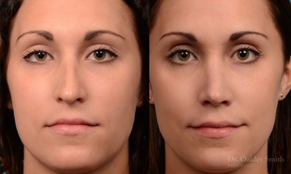 Rhinoplasty Hump removal and straightening