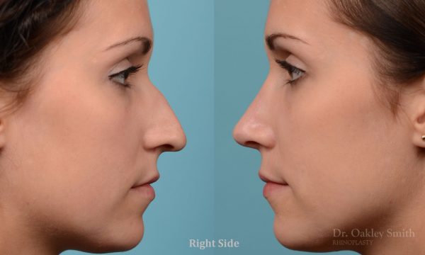 Rhinoplasty Hump removal and straightening