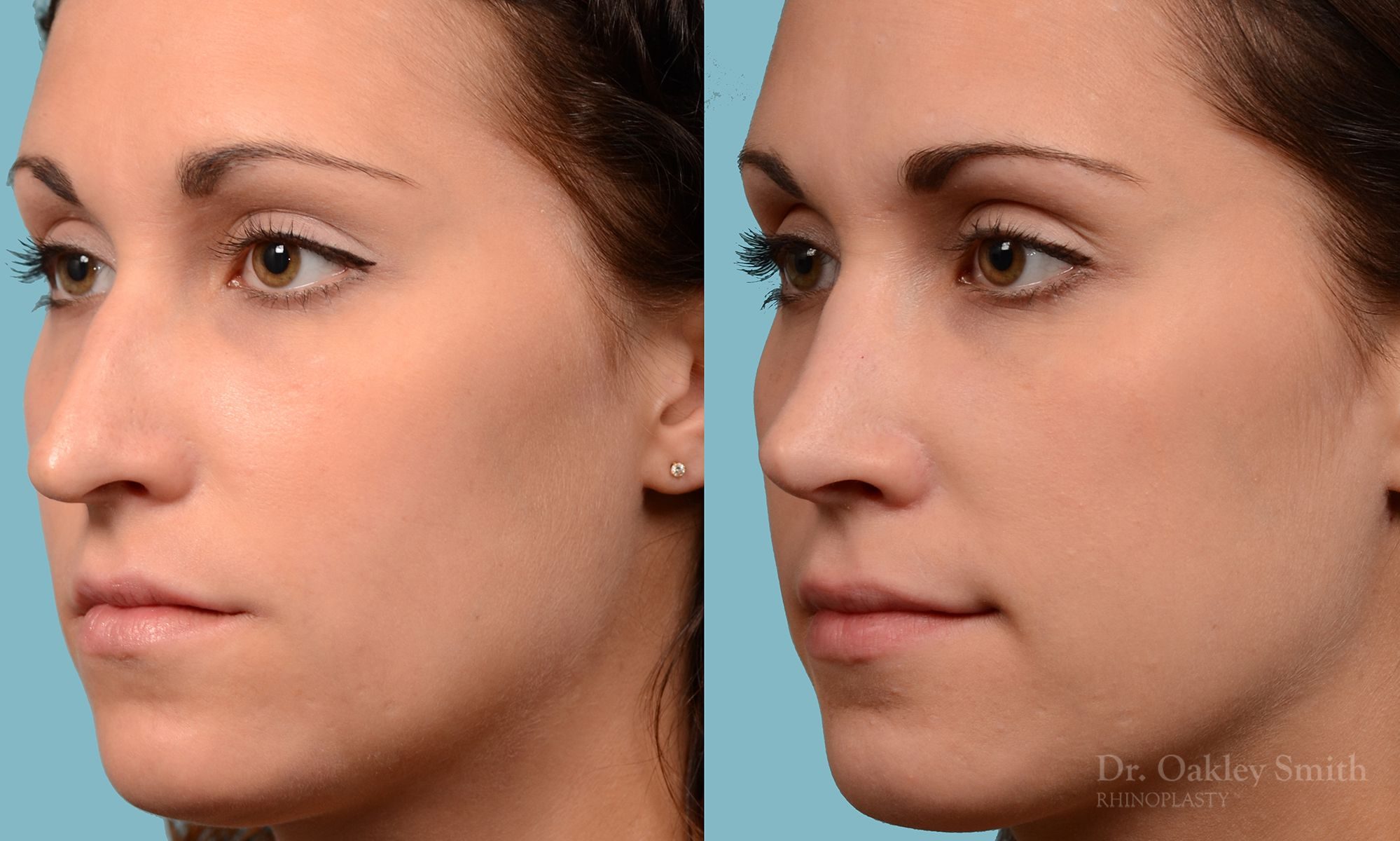 Rhinoplasty Hump removal and straightening