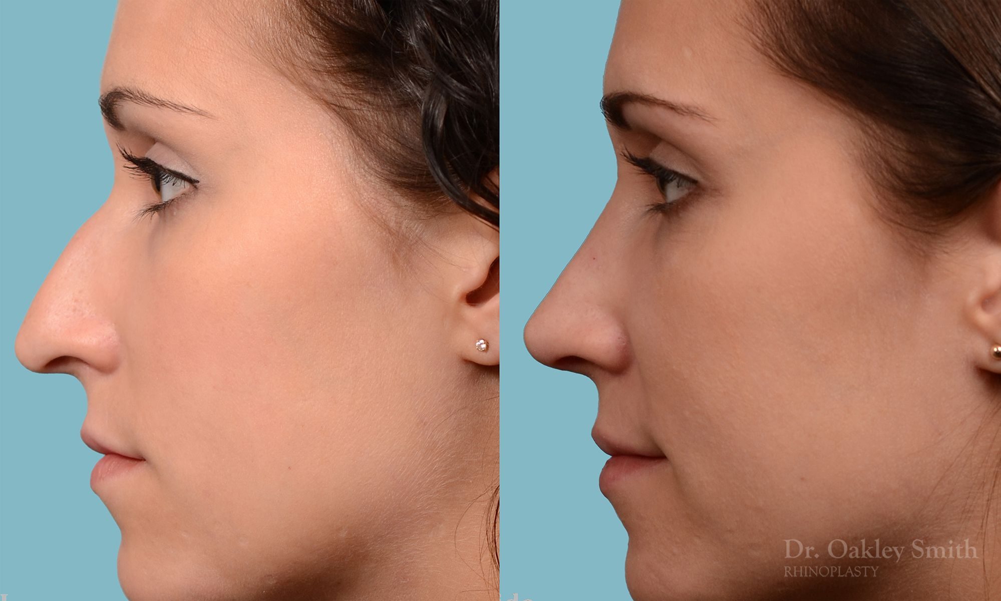 Rhinoplasty Hump removal and straightening
