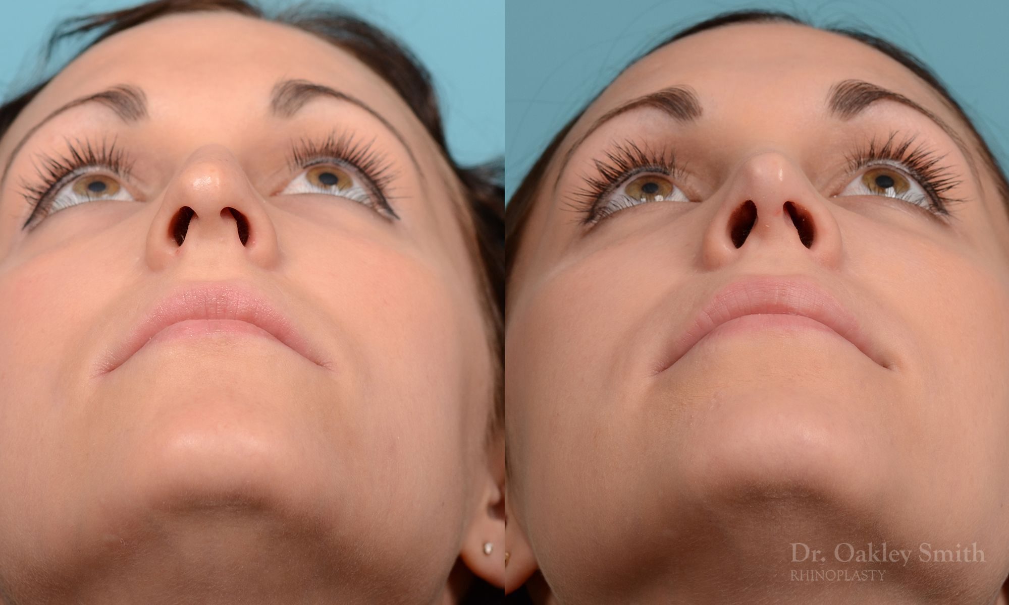 Rhinoplasty Hump removal and straightening
