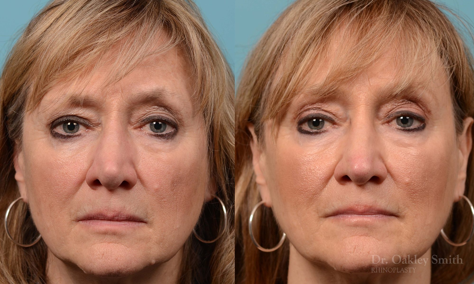 Rhinoplasty to smooth out her nose