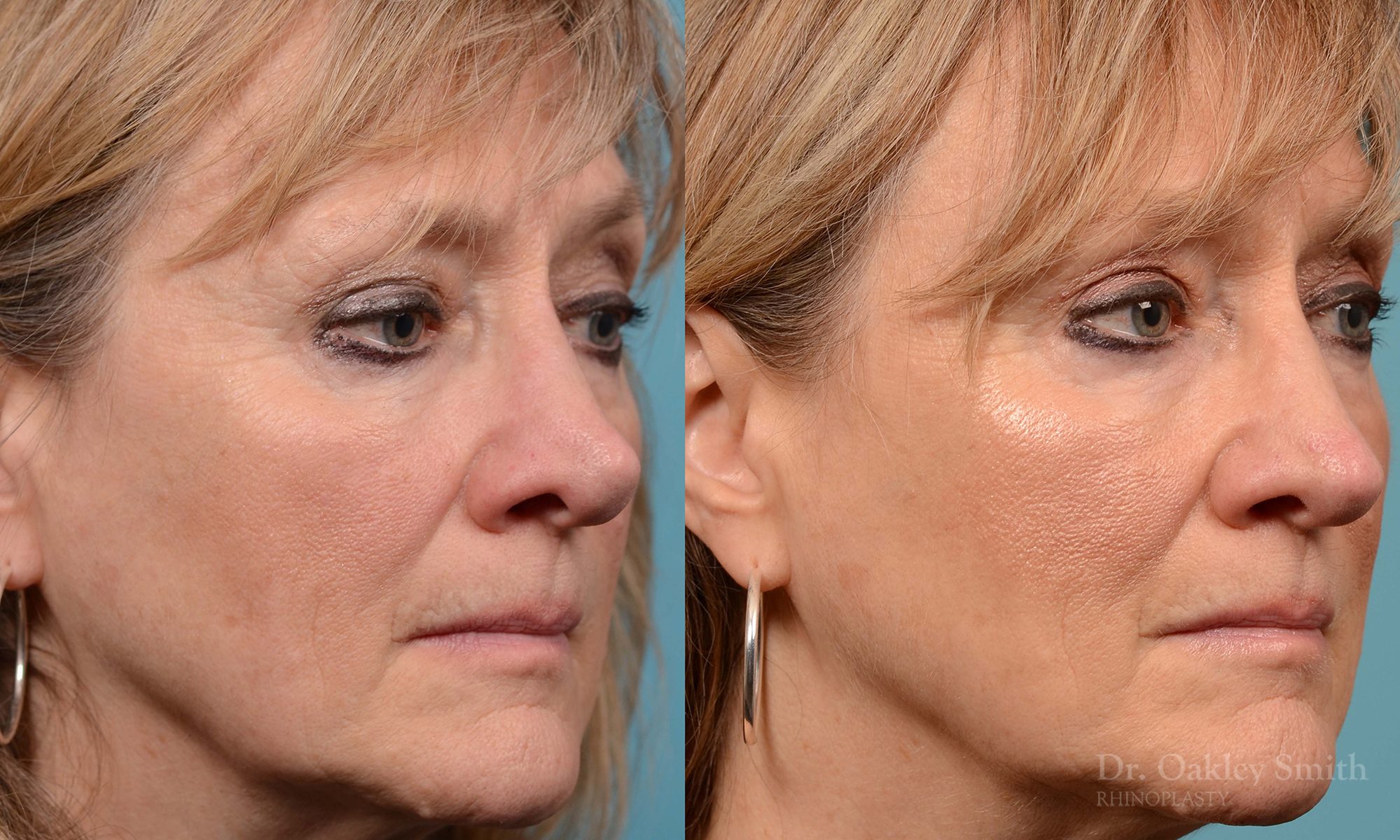 Rhinoplasty to smooth out her nose