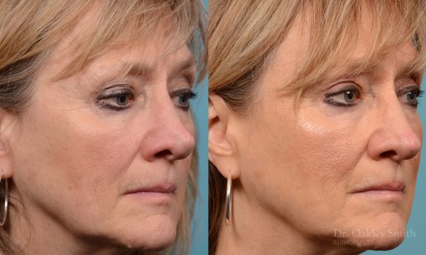 Rhinoplasty to smooth out her nose