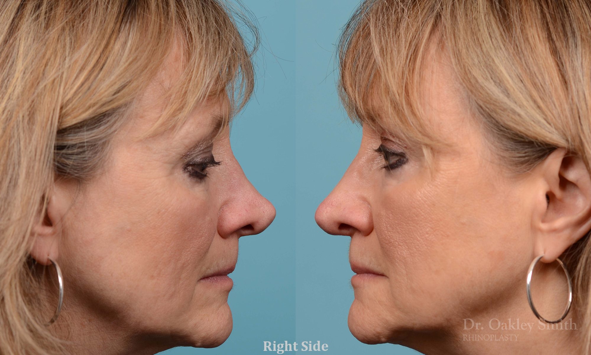 Rhinoplasty to smooth out her nose