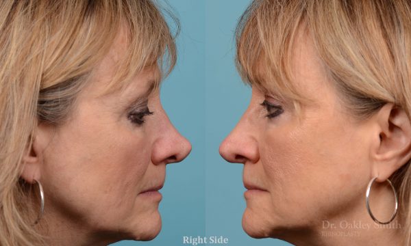 Rhinoplasty to smooth out her nose