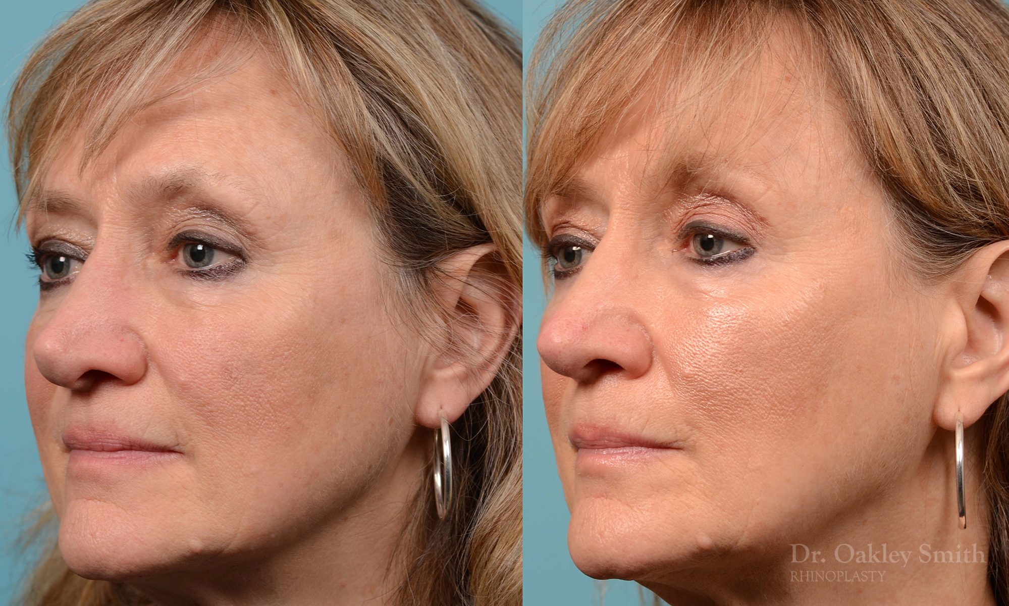 Rhinoplasty to smooth out her nose