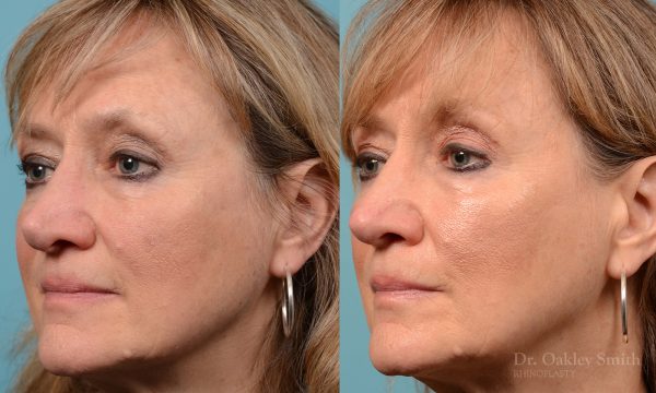 Rhinoplasty to smooth out her nose