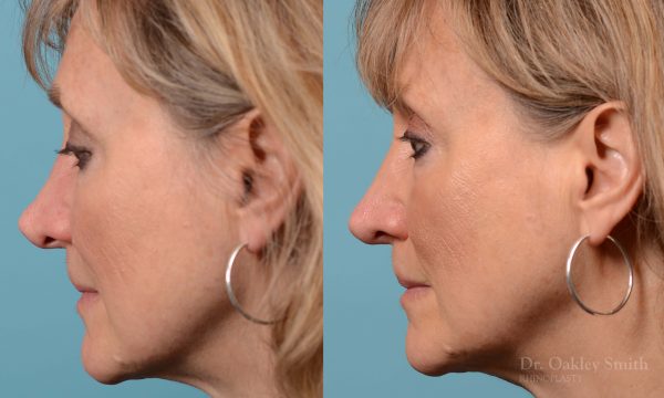 Rhinoplasty to smooth out her nose
