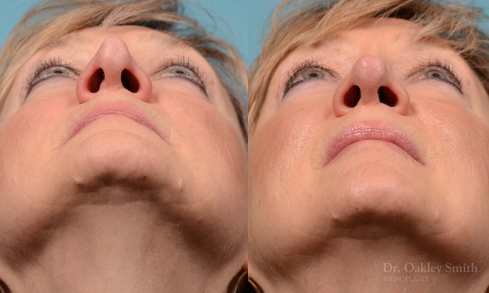 Rhinoplasty to smooth out her nose