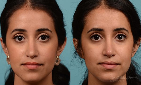 Rhinoplasty