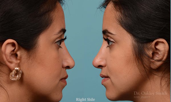 Rhinoplasty