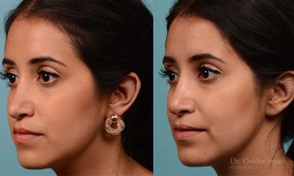 Rhinoplasty