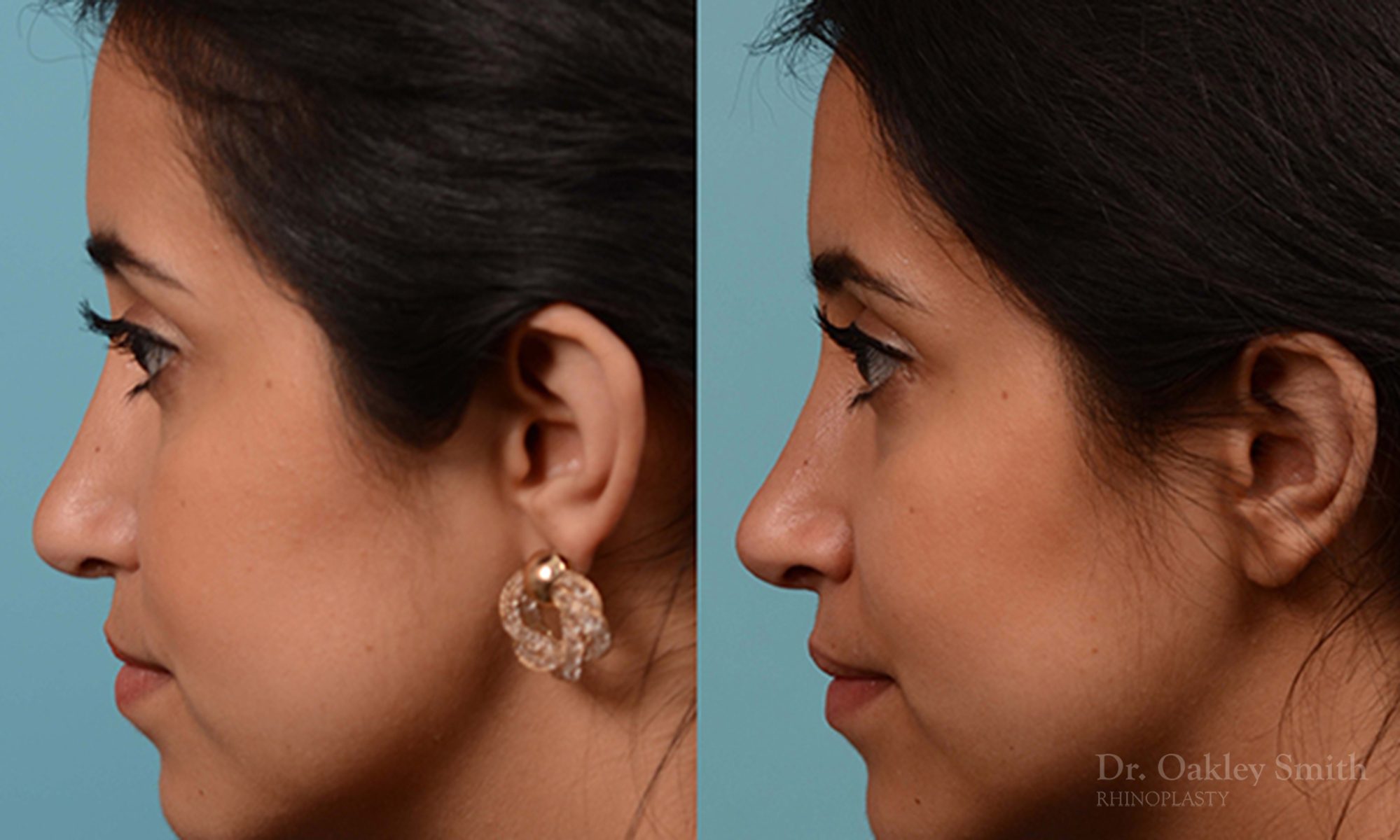Rhinoplasty