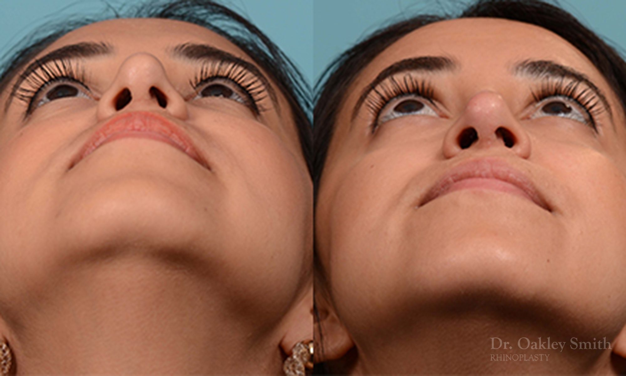 Rhinoplasty