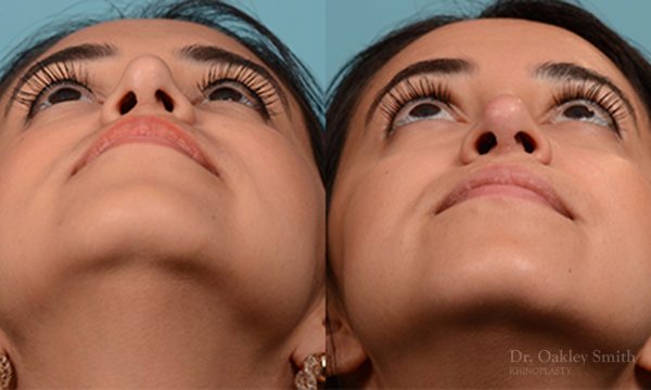 Rhinoplasty
