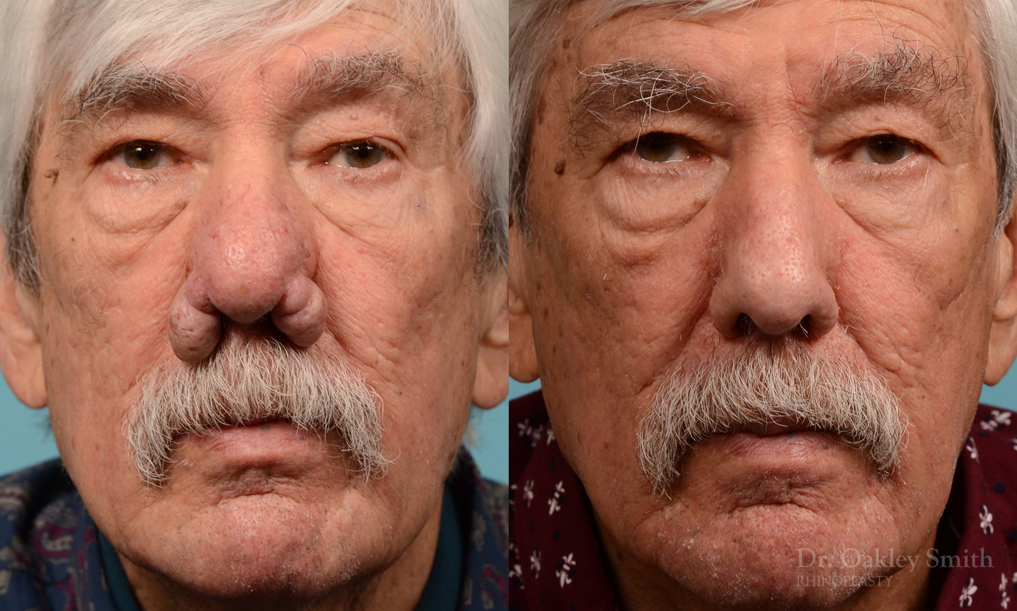 Rhinophyma on elderly man