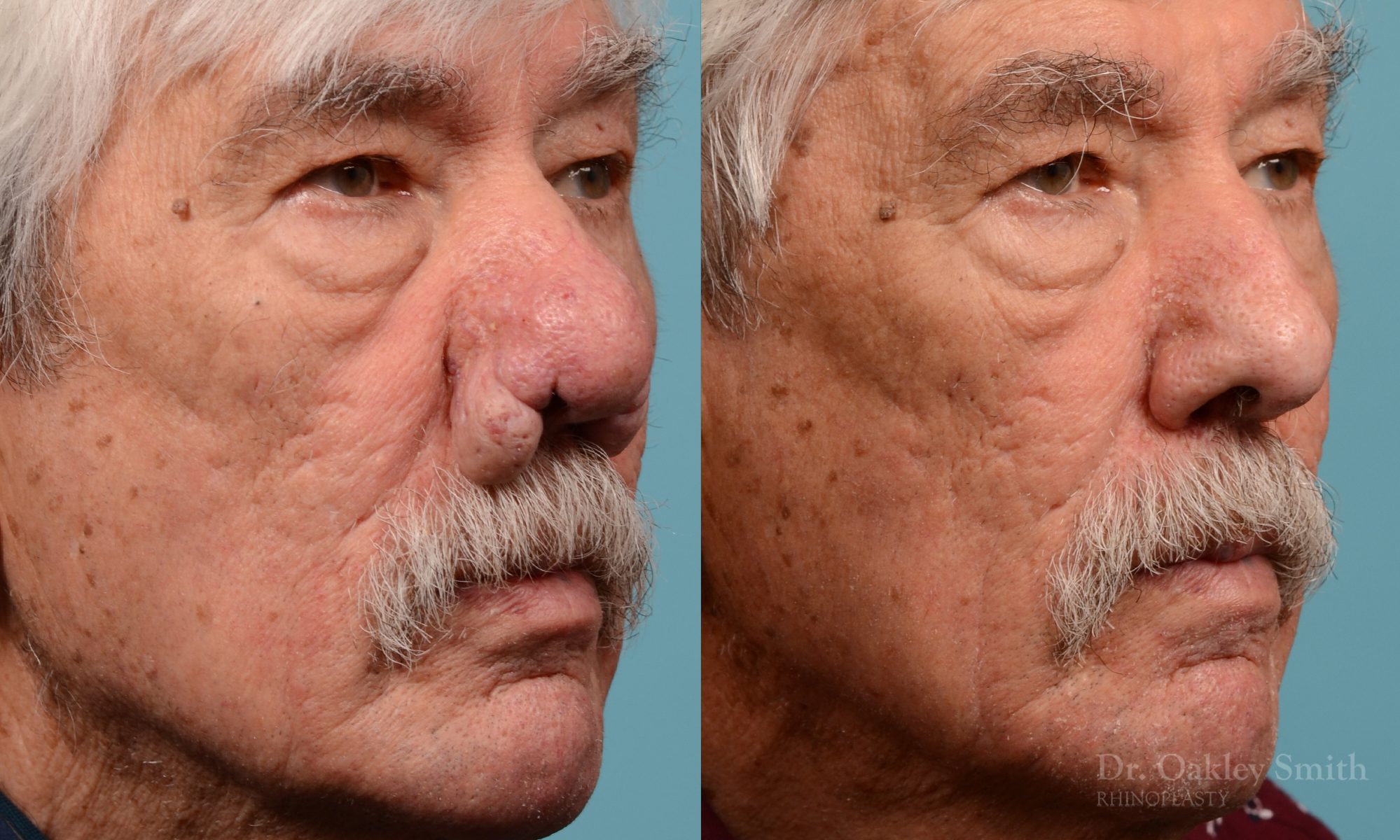 Rhinophyma on elderly man