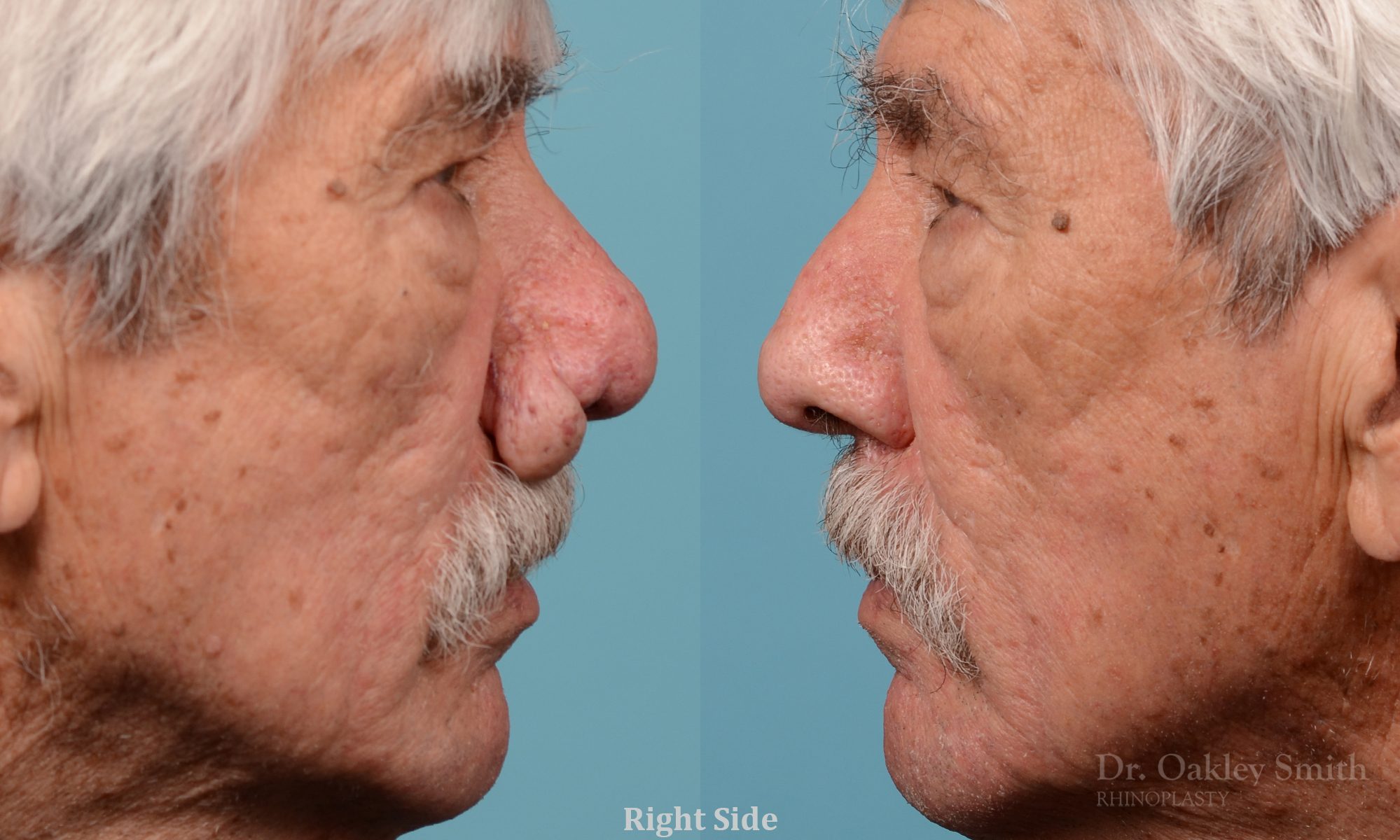 Rhinophyma on elderly man