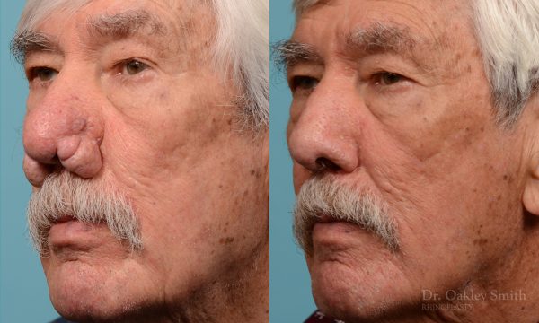 Rhinophyma on elderly man
