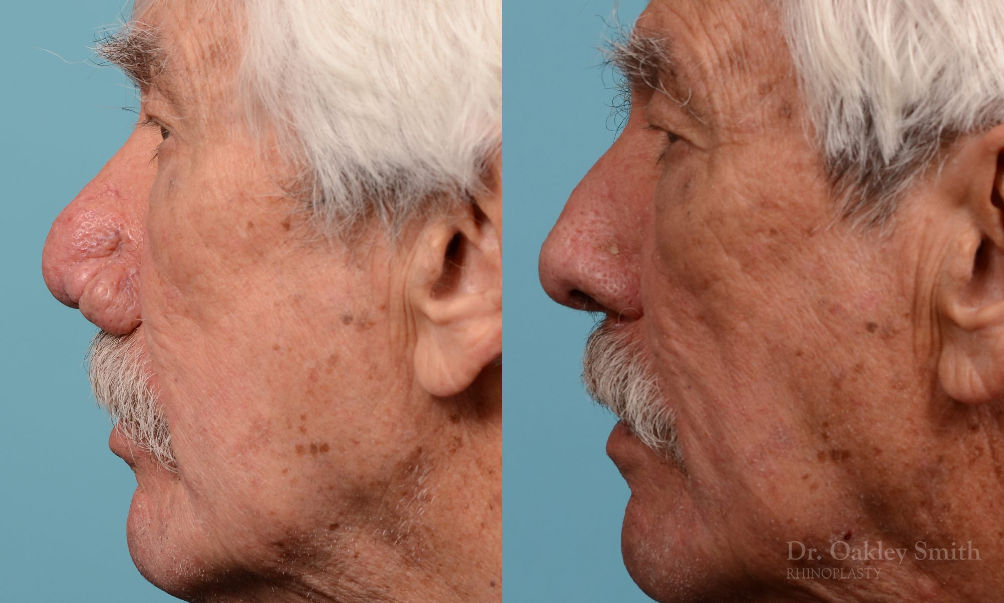 Rhinophyma on elderly man
