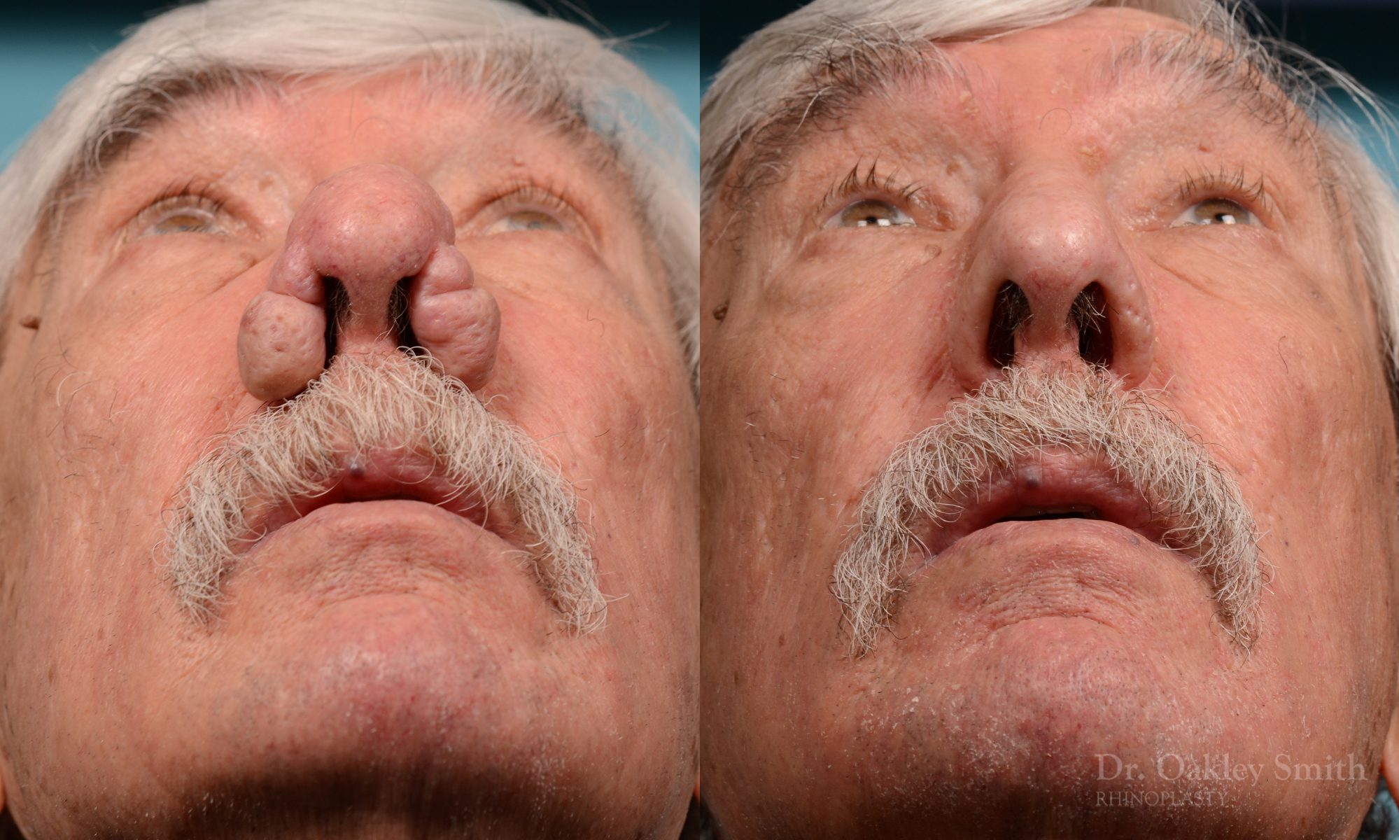 Rhinophyma on elderly man