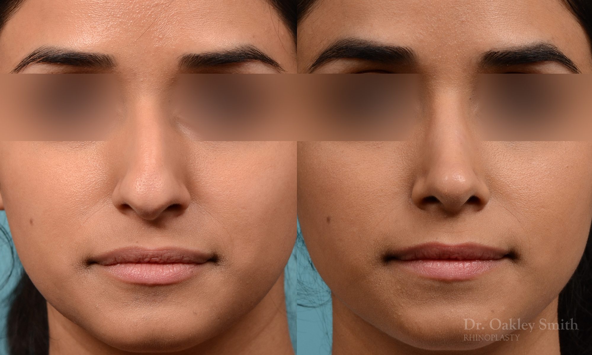 Rhinoplasty hump reduction