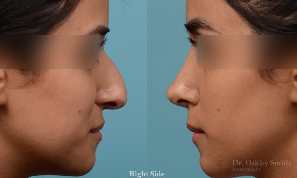 Rhinoplasty hump reduction