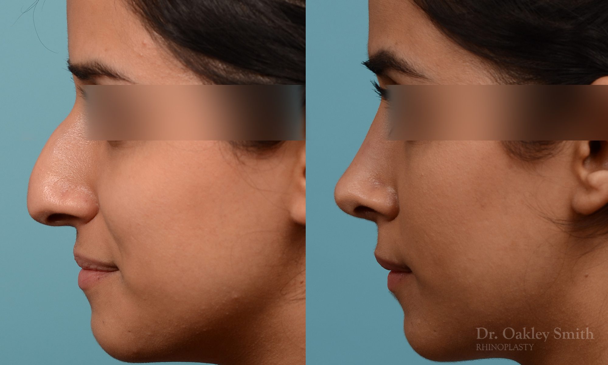 Rhinoplasty hump reduction