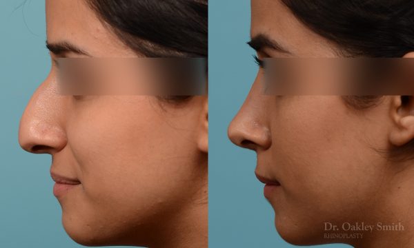 Rhinoplasty hump reduction