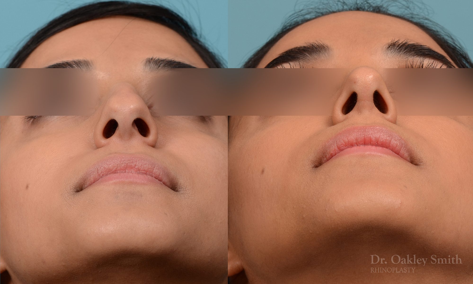 Rhinoplasty hump reduction