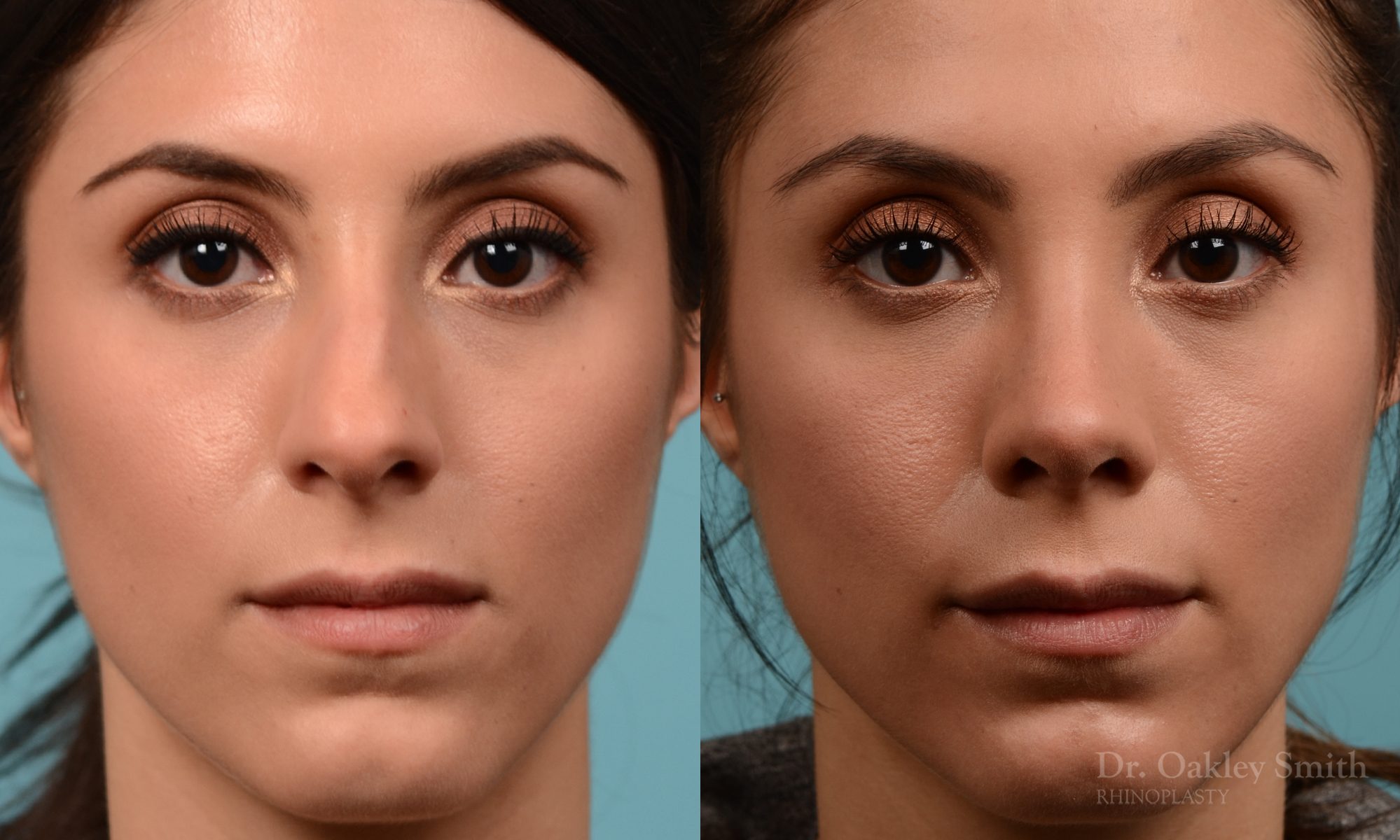 Rhinoplasty to reduce the bridge