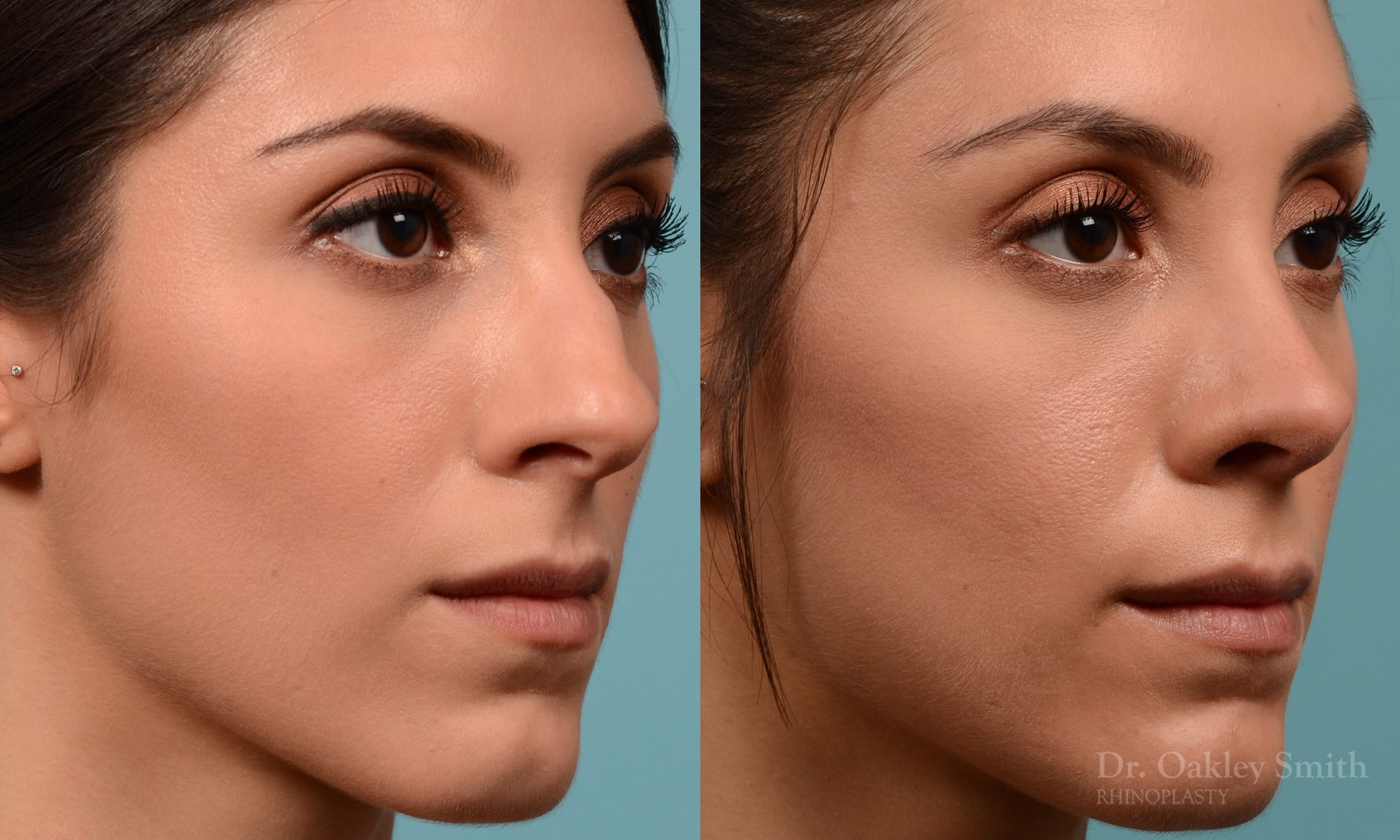 Rhinoplasty to reduce the bridge