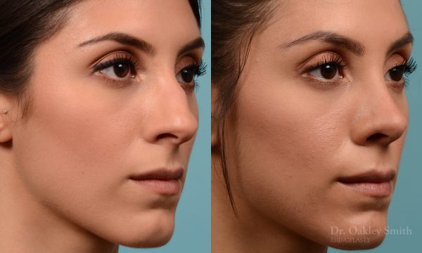 Rhinoplasty to reduce the bridge
