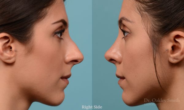 Rhinoplasty to reduce the bridge
