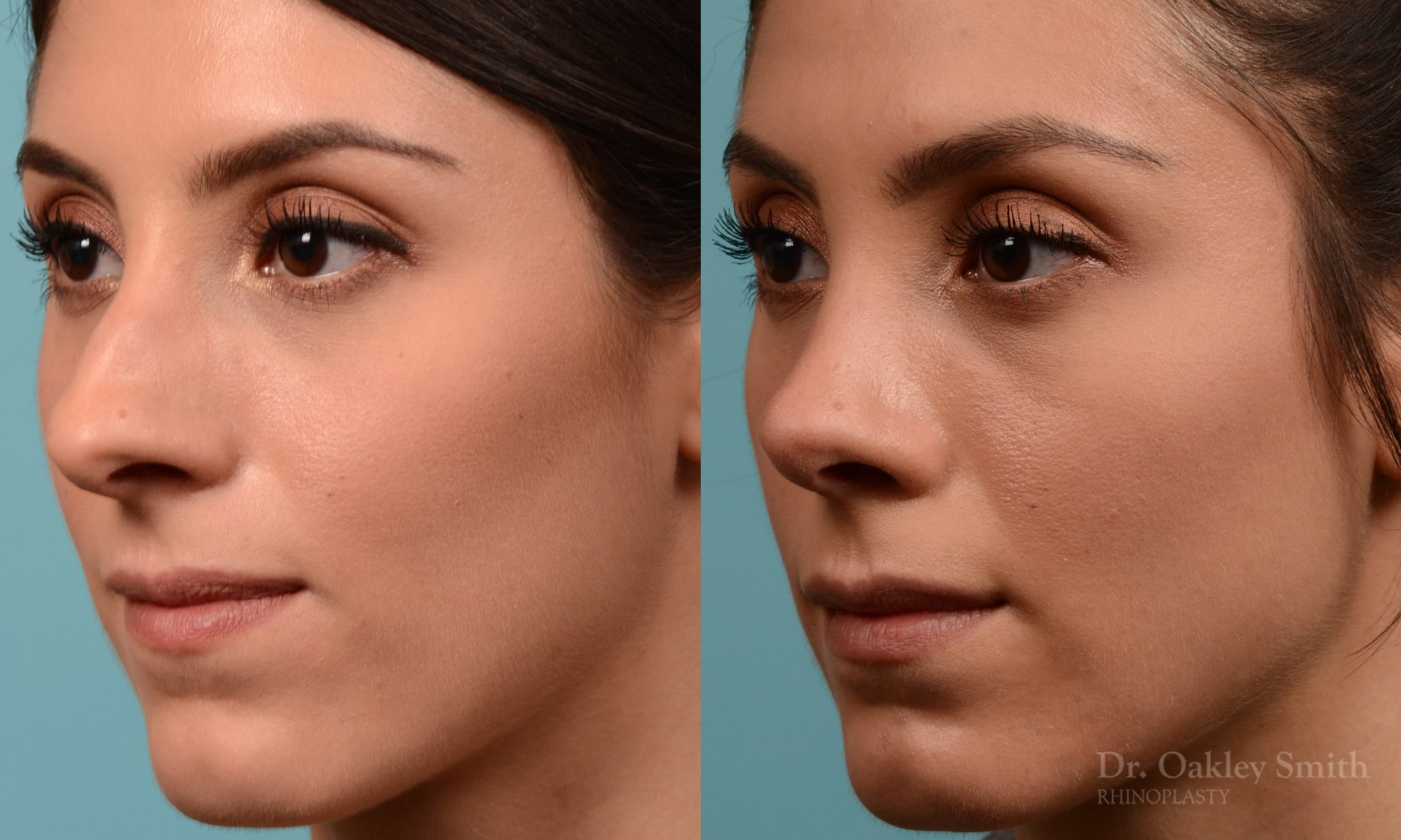 Rhinoplasty to reduce the bridge