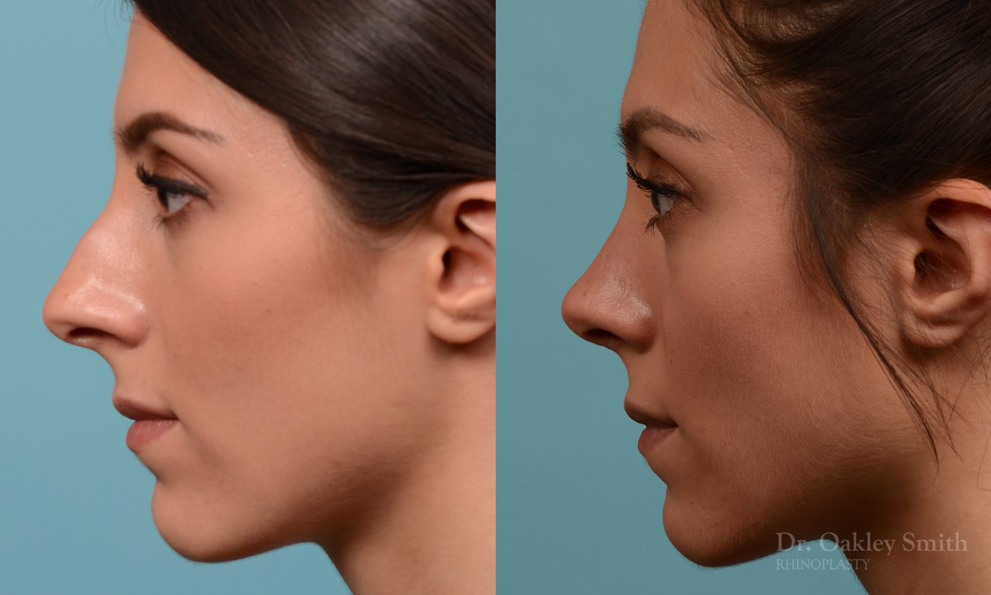 Rhinoplasty to reduce the bridge