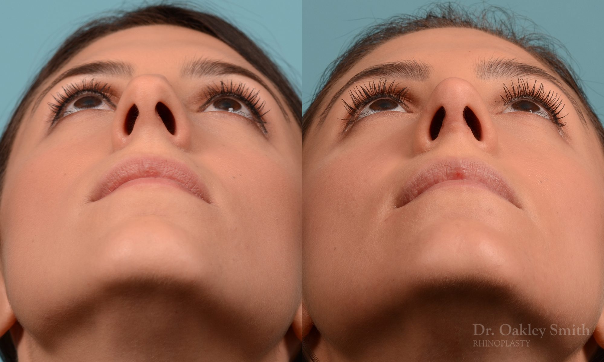Rhinoplasty to reduce the bridge