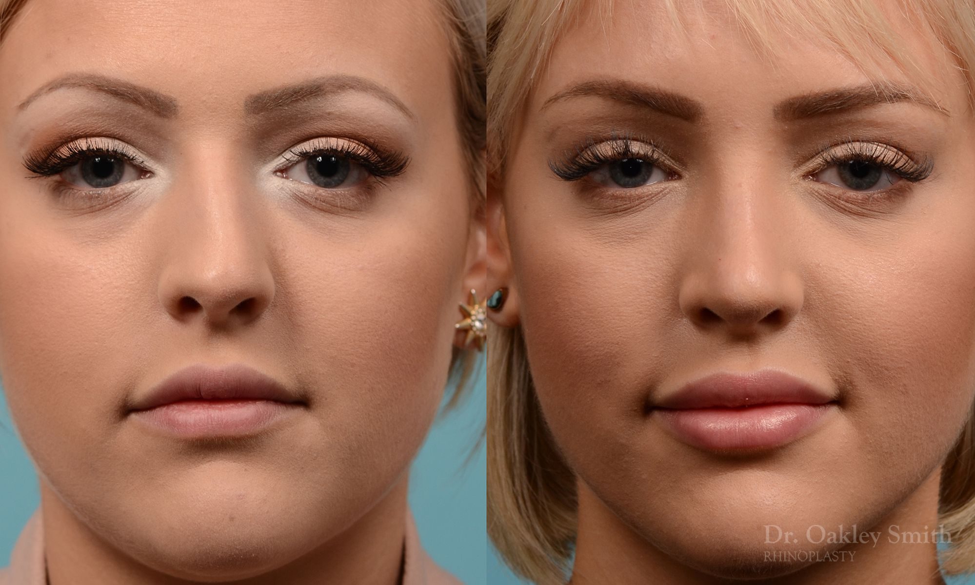 Hump removal and straightening