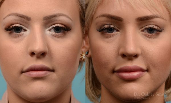 Hump removal and straightening